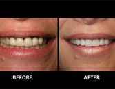 Dental Technique Promises A Younger-Looking Smile Dental Technique Promises A Younger-Looking Smile
