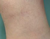Get Rid Of Spider Veins Get Rid Of Spider Veins