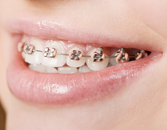 Braces: A Cure for Bad Breath? Braces: A Cure for Bad Breath?
