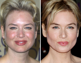 8 Celebrities Who Fixed Their Skin Problems 8 Celebrities Who Fixed Their Skin Problems
