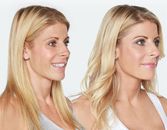 Before & After: Liquid Lift Before & After: Liquid Lift