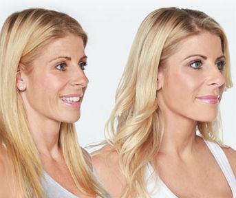 Before & After: Liquid Lift Before & After: Liquid Lift