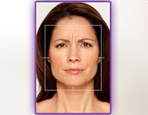 Preview How You Will Look With Botox Preview How You Will Look With Botox