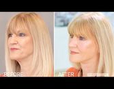 A Procedure That Transforms Linda's Face A Procedure That Transforms Linda's Face